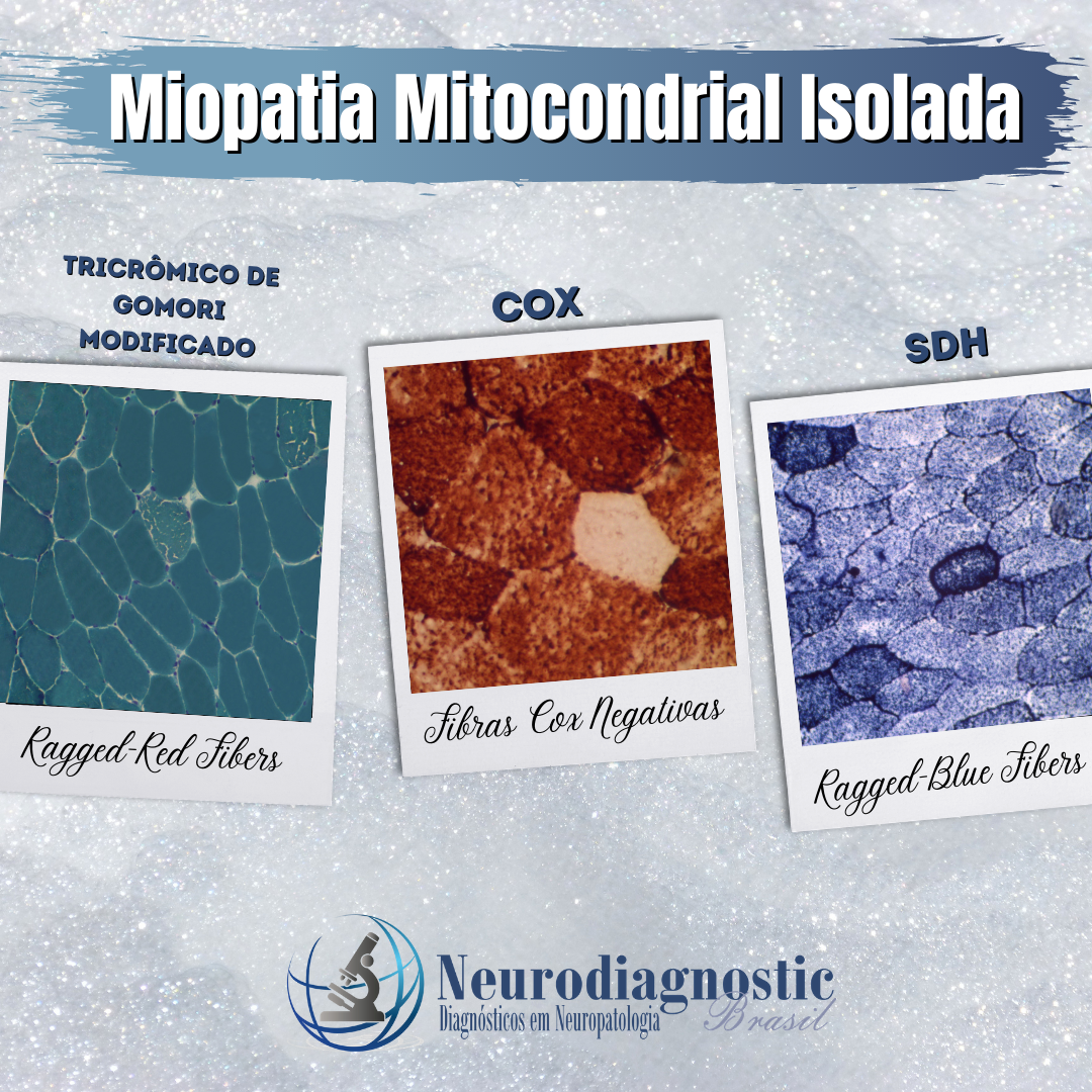 Miopatia Mitocondrial Isolada